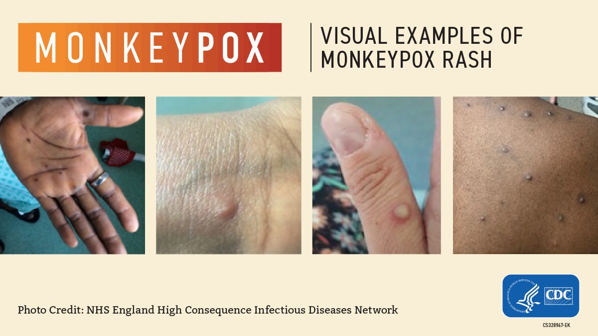 A visual example of Monkeypox rash.